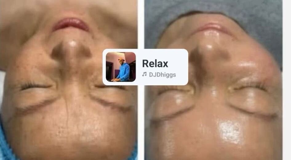 Before and after facial treatment at CKB SKIN CLINIC, Glasgow, Scotland, GB showing smoother skin results.