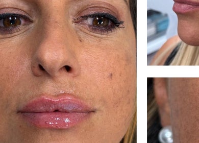 Close-up of rejuvenated skin at Face Harmony, Newmarket, Ontario, CA highlighting flawless complexion.