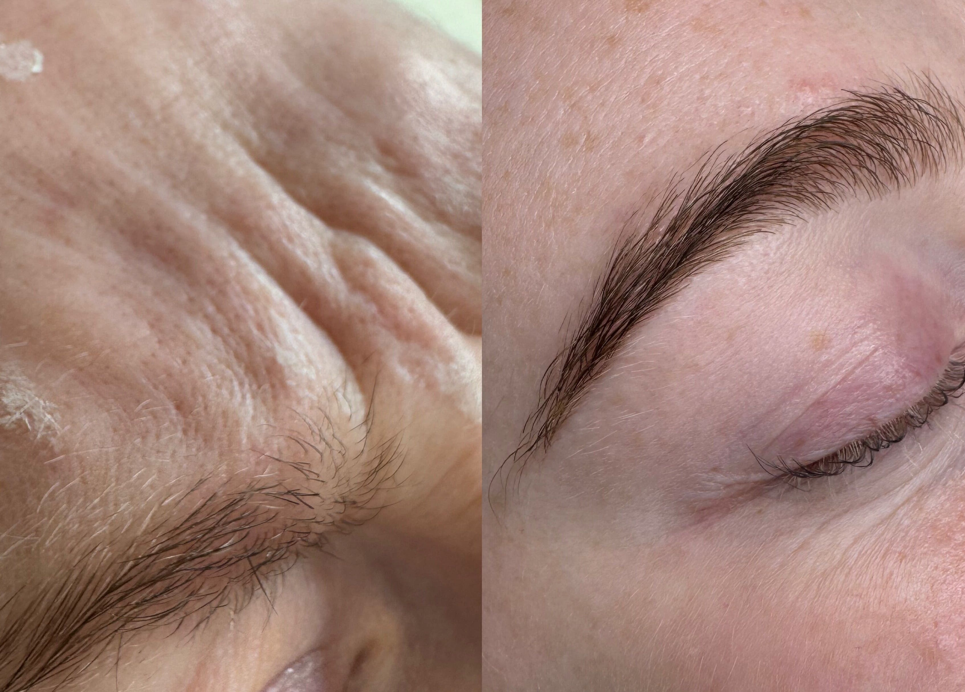 Before and after skin treatment at MCR Medispa, Worsley, England, GB showing noticeable improvement.