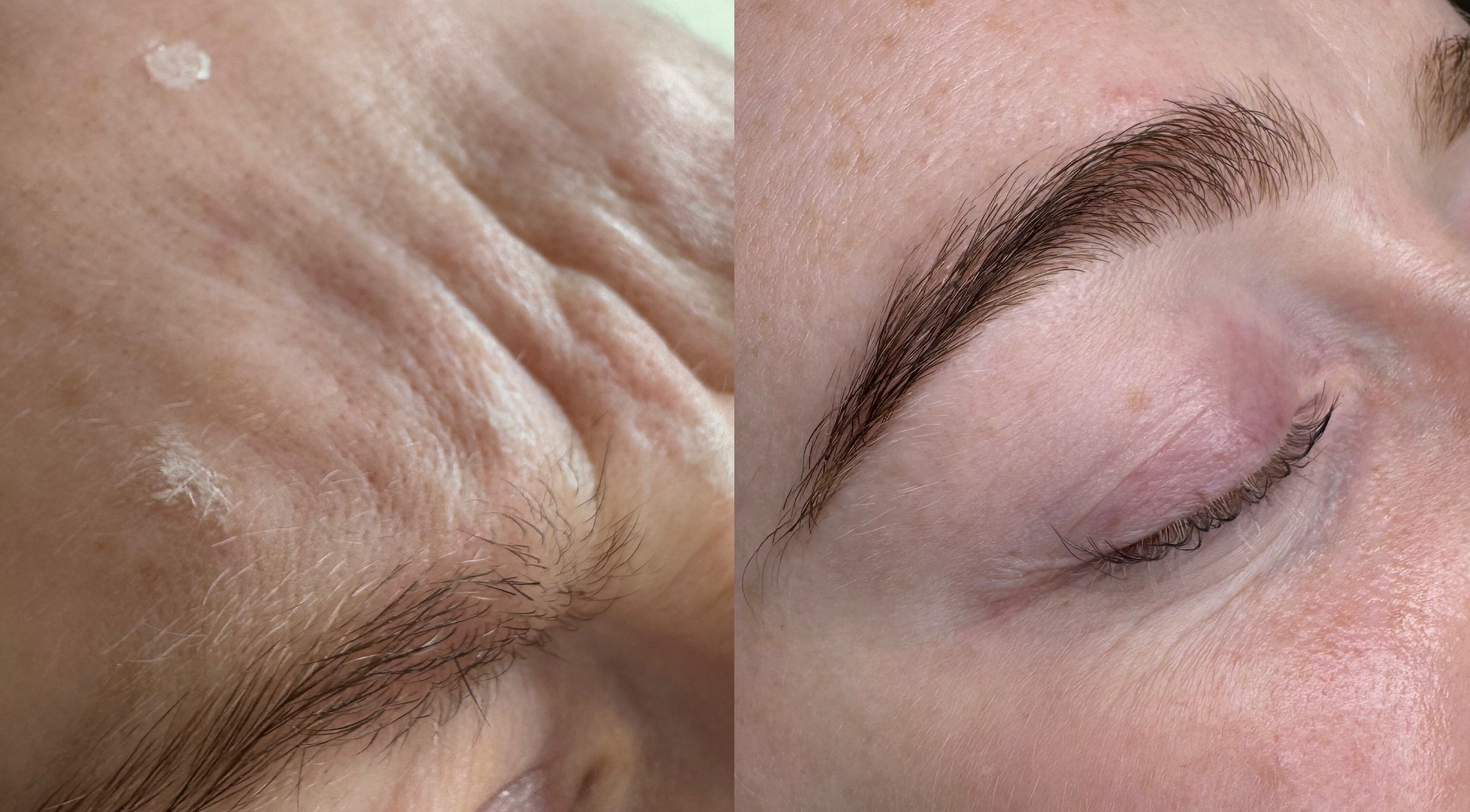 Before and after skin treatment at MCR Medispa, Worsley, England, GB showing noticeable improvement.