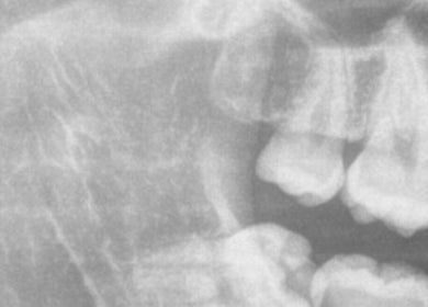 Radiografía dental en Cirujano Dentista-Rosario Alejandre, Ocotlán, Jalisco, MX.
