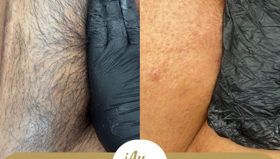 Before and after depilation by ¡Ay, Cera! Depilaciones in La Piedad De Cabadas, Michoacán, MX.
