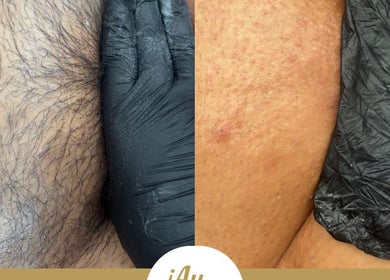 Before and after depilation by ¡Ay, Cera! Depilaciones in La Piedad De Cabadas, Michoacán, MX.