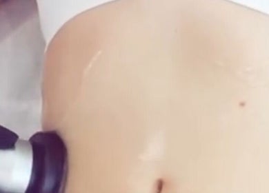 Body contouring procedure at StaceysContour, Wolverhampton, England, GB, showcasing advanced treatment techniques.