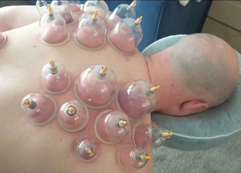 Cupping therapy session at Trudy Wilson Mobile Massage and Holistic Therapies, Larbert, Scotland, GB.