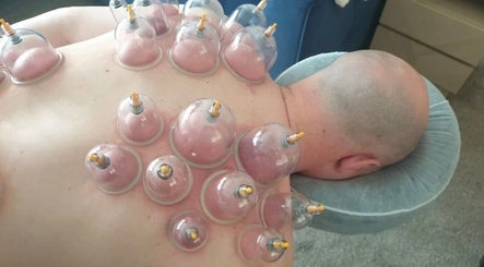 Cupping therapy session at Trudy Wilson Mobile Massage and Holistic Therapies, Larbert, Scotland, GB.