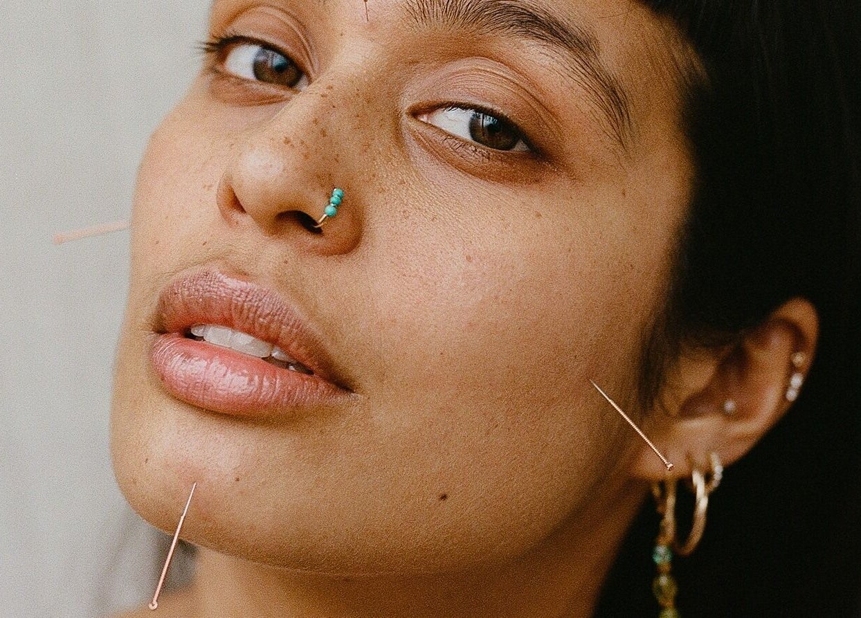 Close-up of acupuncture treatment at Cassie Adams Acupuncture at In Our Neighbourhood Apothecary, London, England, GB.