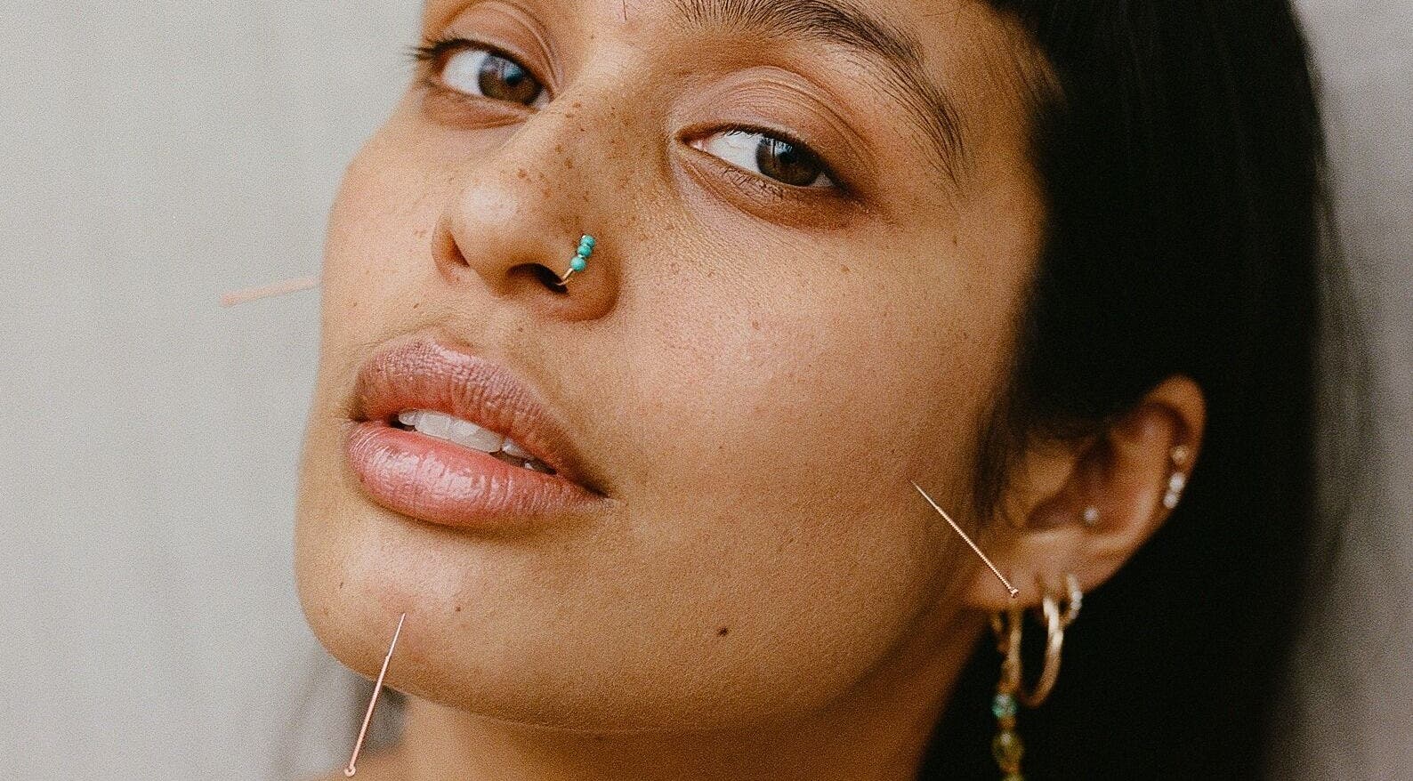 Close-up of acupuncture treatment at Cassie Adams Acupuncture at In Our Neighbourhood Apothecary, London, England, GB.