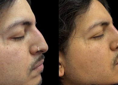 Before and after skin treatment at Casa de Luxe Las Vegas, Las Vegas, Nevada, US.