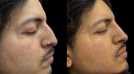 Before and after skin treatment at Casa de Luxe Las Vegas, Las Vegas, Nevada, US.