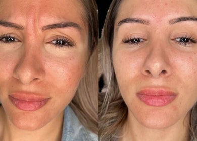 Before and after facial treatment at Casa de Luxe Las Vegas, showcasing clear skin in Las Vegas, Nevada, US.