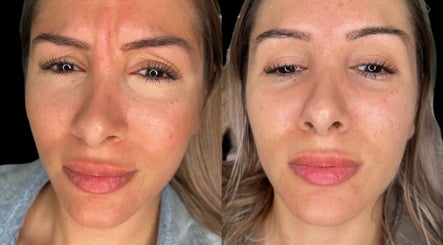 Before and after facial treatment at Casa de Luxe Las Vegas, showcasing clear skin in Las Vegas, Nevada, US.