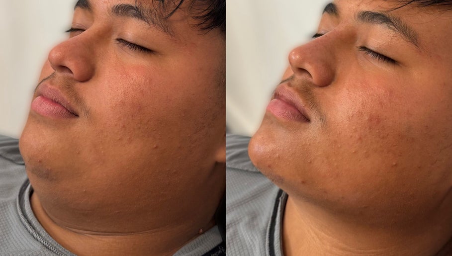 Before and after skin treatment at Casa de Luxe Bakersfield, Bakersfield, California, US.