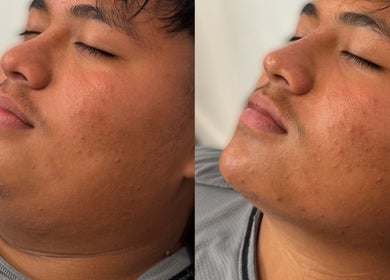 Before and after skin treatment at Casa de Luxe Bakersfield, Bakersfield, California, US.