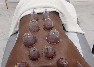 Cupping therapy at JA Sports Injuries, Oldbury, England, GB enhances recovery and wellness.