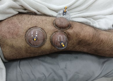 Cupping therapy session at JA Sports Injuries, Oldbury, England, GB for muscle recovery.