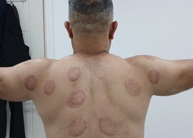 Cupping therapy marks on a man's back at JA Sports Injuries, Oldbury, England, GB.