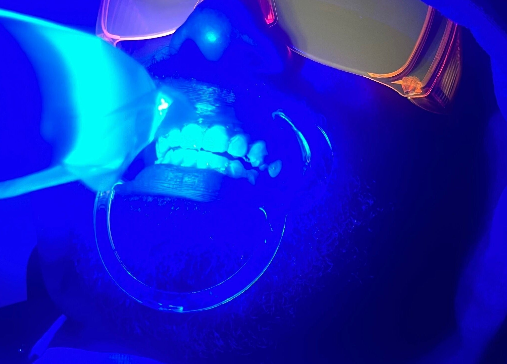 A teeth whitening session at IVRY, Pawling, New York, US, with a blue UV light enhancing the brightness.