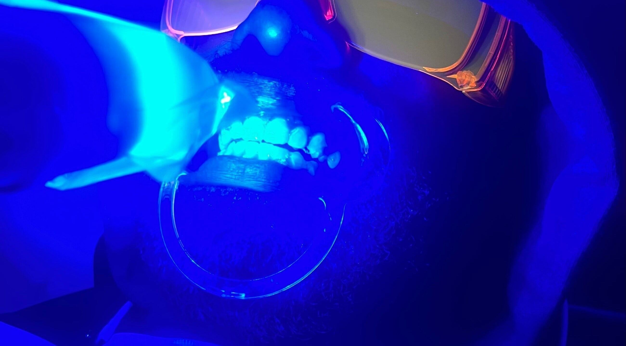 A teeth whitening session at IVRY, Pawling, New York, US, with a blue UV light enhancing the brightness.