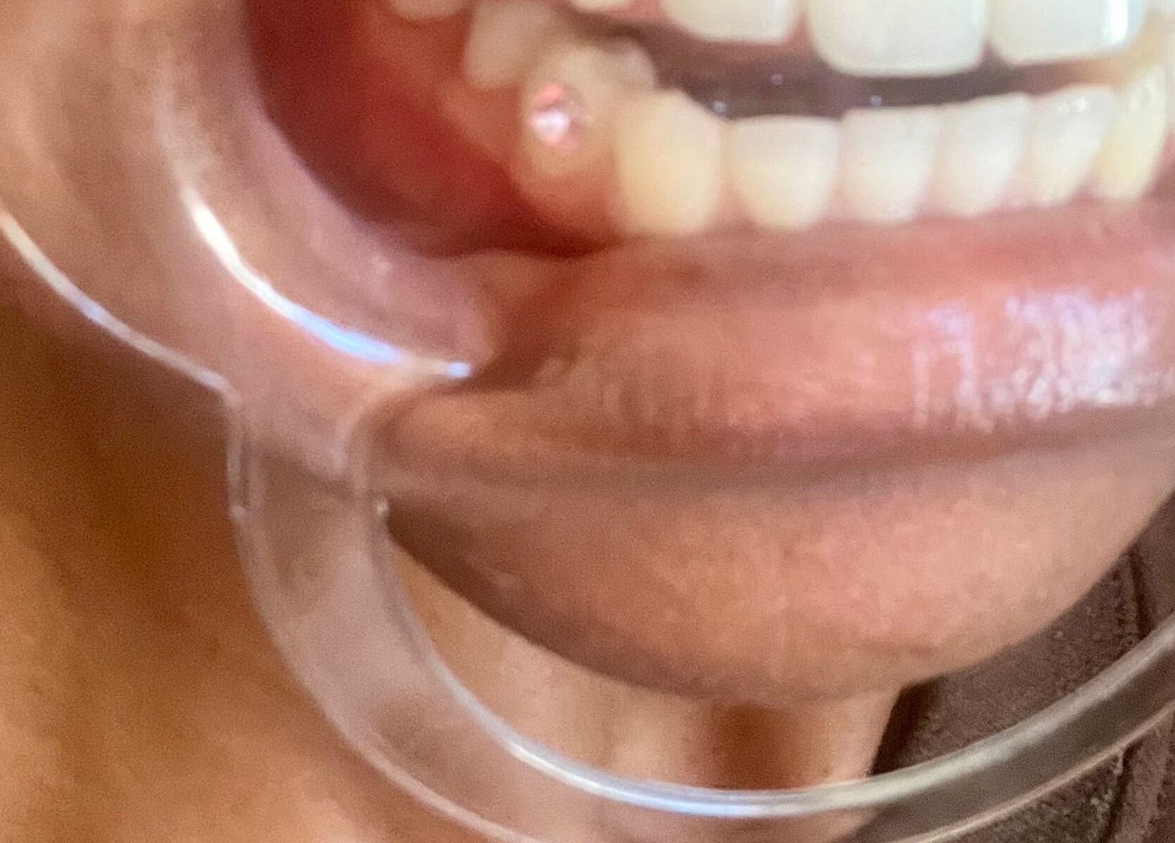 Close-up of a dental procedure at IVRY, Pawling, New York, US showcasing a bright smile.