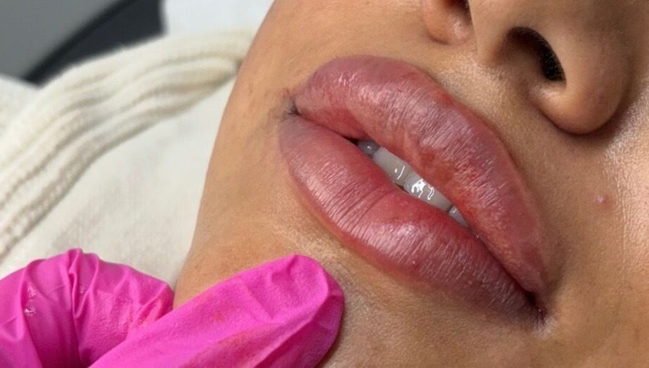 Close-up of lip enhancement at ML Aesthetics, Accrington, England, GB.