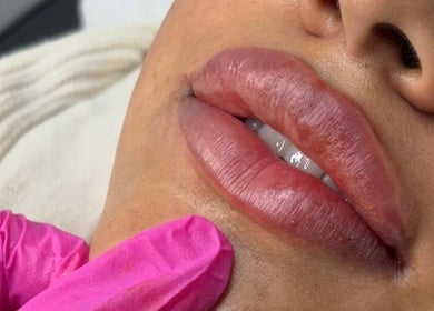 Close-up of lip enhancement at ML Aesthetics, Accrington, England, GB.