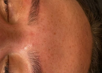 Close-up of a client's rejuvenated skin at BeautyByElls, Riddings, England, GB, showcasing clear complexion.