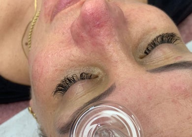 Terapia de ventosas faciais na Beauty Vanessa Tavares, Dublin, County Dublin, IE.