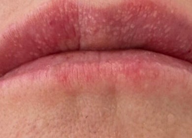 Closeup of lips illustrating skin texture at Morning Dew Health and Beauty, Sutton-in-ashfield, England, GB.