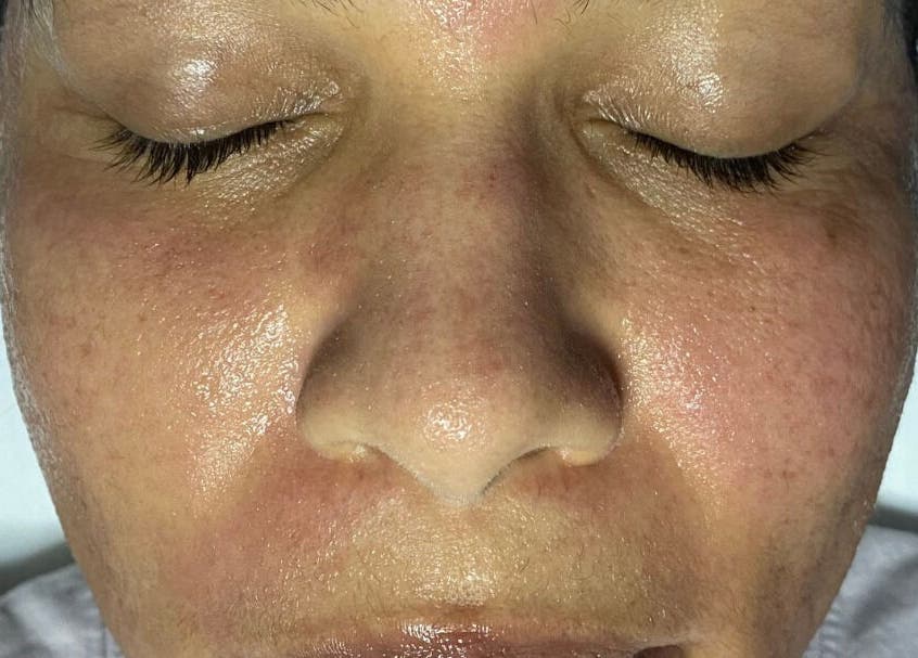 Close-up of glowing skin after a facial at Skinnin, Conway, Arkansas, US, showcasing smooth, revitalized texture.