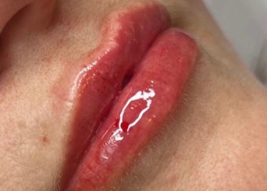 Close-up of enhanced lips at Resculpt Aesthetics, Fareham, England, GB, showcasing glossy finish.