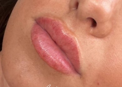 Close-up of lip enhancement at Resculpt Aesthetics, Fareham, England, GB, showcasing smooth, plump lips.