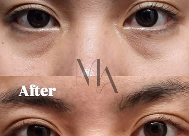 Before and after eye treatment results at Mae Medical Aesthetics, London, England, GB. Noticeable improvement shown.