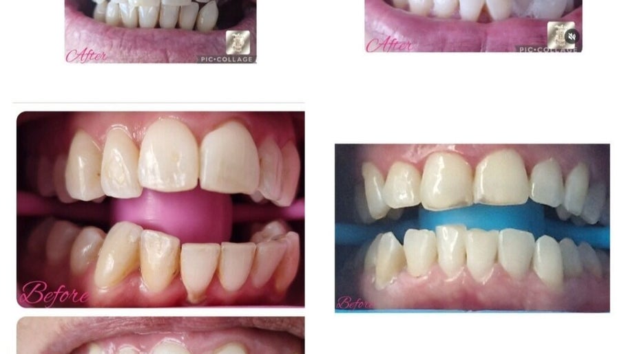 Teeth whitening before and after by Beautybyl0zx, Birmingham, England, GB, showing a dramatic improvement.