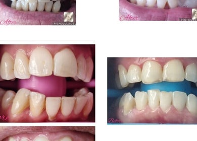 Teeth whitening before and after by Beautybyl0zx, Birmingham, England, GB, showing a dramatic improvement.