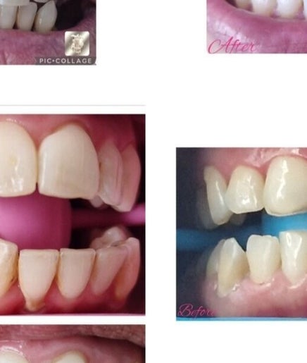 Teeth whitening before and after by Beautybyl0zx, Birmingham, England, GB, showing a dramatic improvement.
