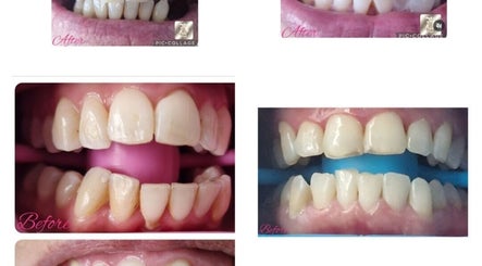 Before and after teeth whitening at Beautybyl0zx, Birmingham, England, GB, showing remarkable dental transformation.