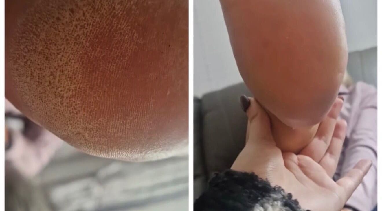 Before-and-after heel care at Beautybyl0zx, Birmingham, England, GB. Noticeable transformation of heel skin texture.