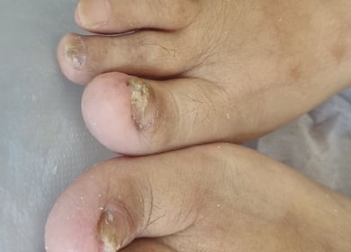Tratamiento de uñas en Podologia anita, Huechuraba, Región Metropolitana, CL.