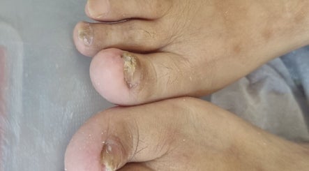 Tratamiento de uñas en Podologia anita, Huechuraba, Región Metropolitana, CL.