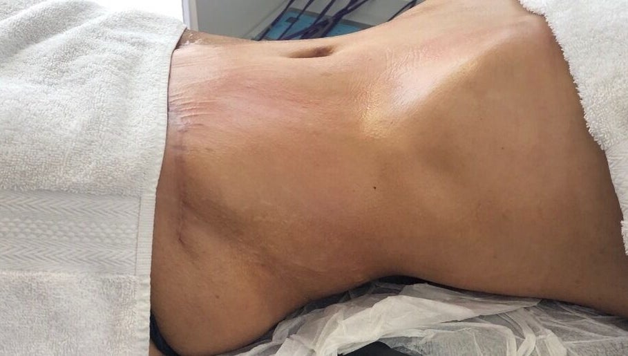 Tratamiento de abdomen en Diosas Studio Spa, Bucaramanga, Santander, CO.
