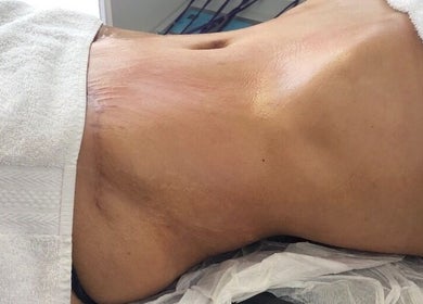 Tratamiento de abdomen en Diosas Studio Spa, Bucaramanga, Santander, CO.