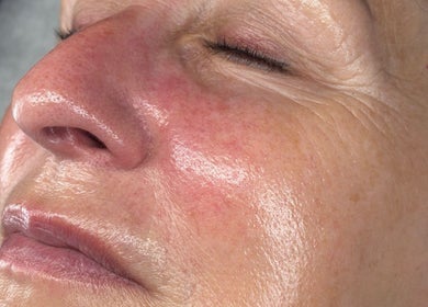 Close-up of a fresh, glowing facial treatment at Newelle Beauty in London, England, GB.