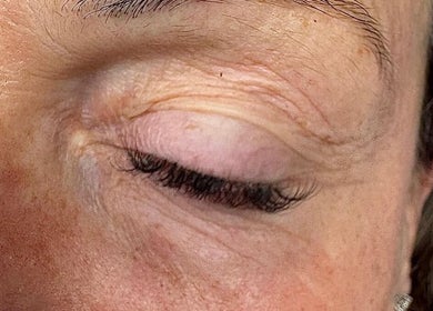 Close-up of an eye treated at Club Esthetique, Suffolk Park, NSW, AU, showcasing smooth skin results.