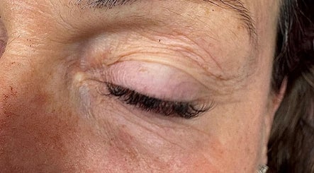 Close-up of an eye treated at Club Esthetique, Suffolk Park, NSW, AU, showcasing smooth skin results.