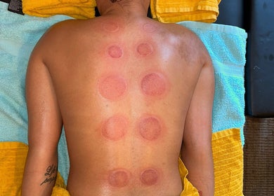 Cupping therapy session at 7 Fitness, Derby, England, GB showcases circular marks on a person's back.