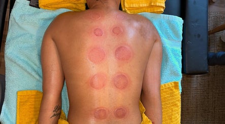 Cupping therapy session at 7 Fitness, Derby, England, GB showcases circular marks on a person's back.