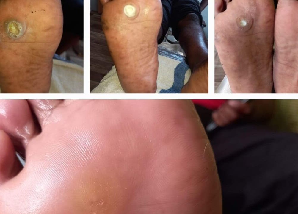 Foot care treatment at Senior Touch Mobile Spa, Chaguanas, Chaguanas, TT showing before and after results.