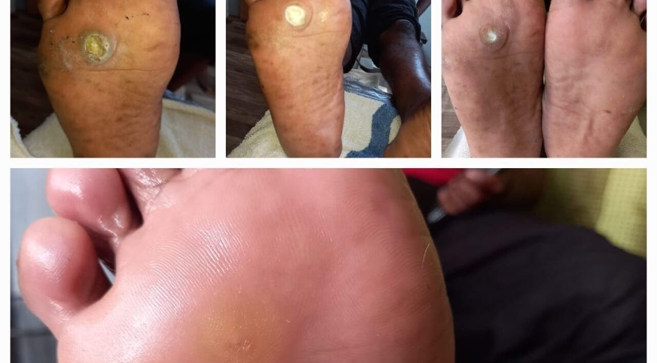 Foot care treatment at Senior Touch Mobile Spa, Chaguanas, Chaguanas, TT showing before and after results.