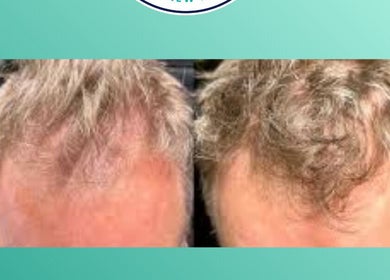 Hair transformation at SKIN TONE CLINIC in London, England, GB, showing significant improvement.